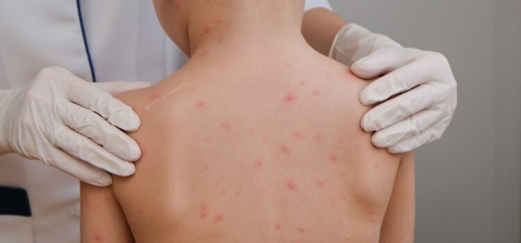 Guerrero es cuarto lugar nacional de casos de sarampión